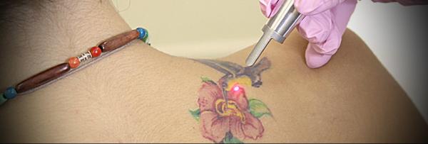Основные методы удаления татуировок